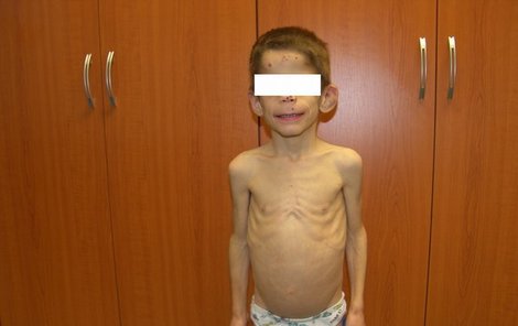 Podvyživený Dominik (8) vážil při výšce 102 cm jen 13,5 kilogramu, což odpovídá  váze tříletého dítěte...