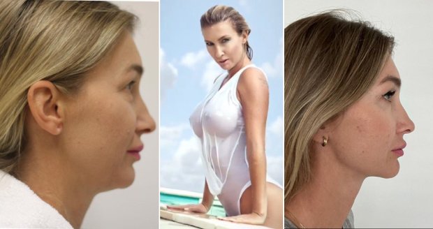 Dominika Mesarošová před a po zákroku