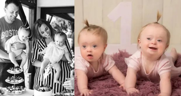 Pravděpodobnost, že se narodí dvojvaječná dvojčata s touto diagnózou je jednou za 140–200 let.