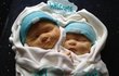 Dort při narození dvojčátek