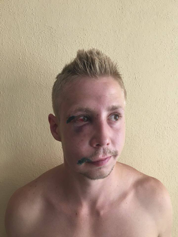 Takhle dopadl mladík, kterého napadla skupina mužů, pole svědků Romů, na koupališti v Dubí na Teplicku. Fotografie zveřejnil na sociálních sítích jeho švagr.