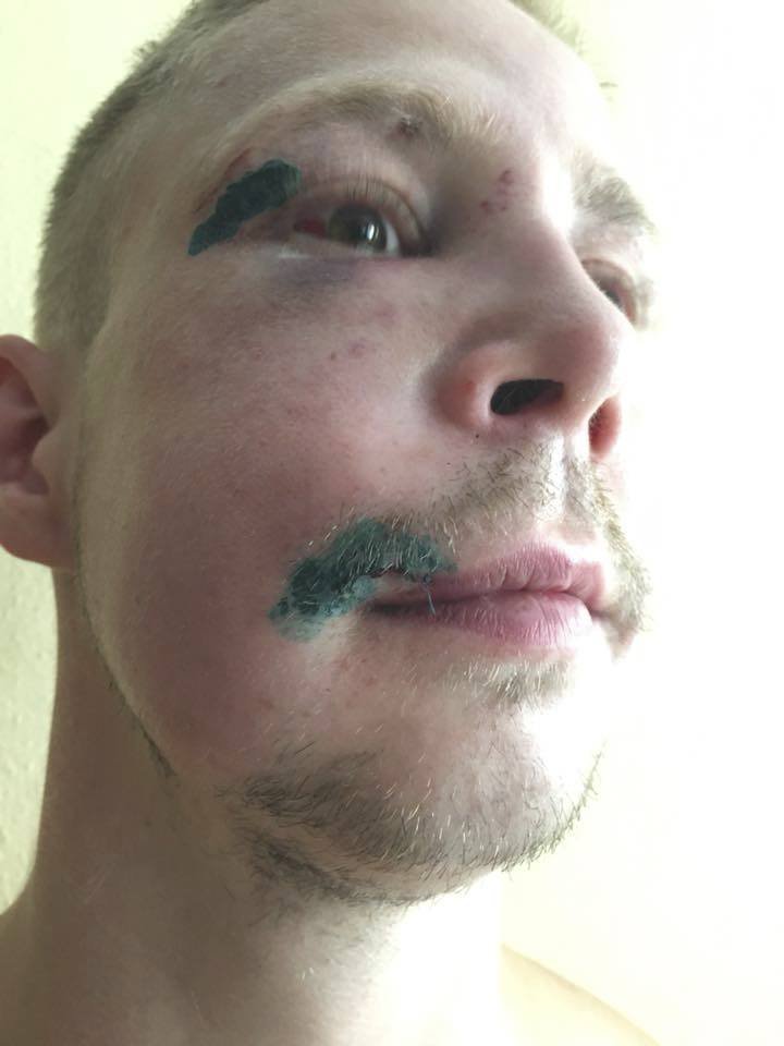 Takhle dopadl mladík, kterého napadla skupina mužů, podle svědků Romů, na koupališti v Dubí na Teplicku. Fotografie zveřejnil na sociálních sítích jeho švagr.