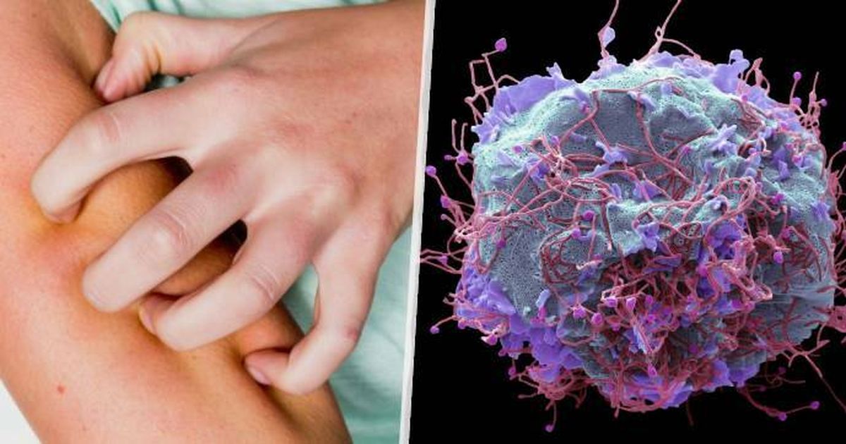 Hmpv Rime Rash Virus HMPV: Pozor na kožní problémy, varují experti | Blesk.cz