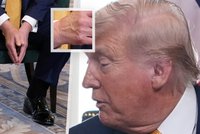 Další pochyby o Trumpově zdraví: Nateklé kotníky ve Skotsku a skvrna na ruce pod make-upem?