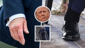Letošní zdravotní trable Trumpa: Oteklé kotníky, modřiny, kulhání... a záměna testu na demenci s IQ testem.