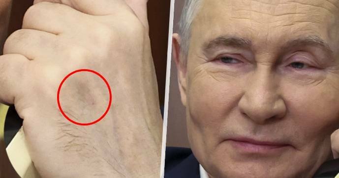 Další spekulace o Putinově chatrném zdraví: Zarudlé oči a modřiny