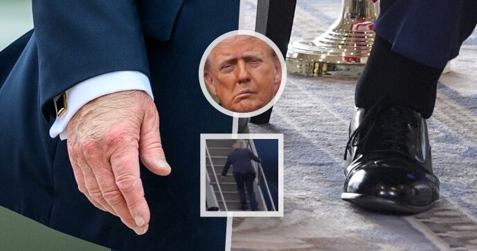 Letošní zdravotní trable Trumpa: Oteklé kotníky, modřiny, kulhání... a záměna testu na demenci s IQ testem.