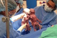 Dvojčátka se vzácnou diagnózou se při porodu držela za ručičky