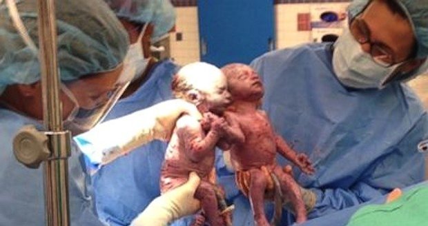 Dvojčátka se vzácnou diagnózou se při porodu držela za ručičky