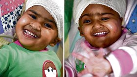 Trišna (vlevo) a Krišna už po operaci. Všichni jim drží palce, aby se holčičky zotavily a vedly normální život... 