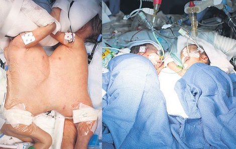 Děvčátka se narodila 10. prosince. Měla srostlá játra a hrudníky. Lydia (L) a Maya (P) po operaci. Staly se nejmladšími siamskými dvojčaty, které operaci podstoupily. Tým zázračných lékařů…