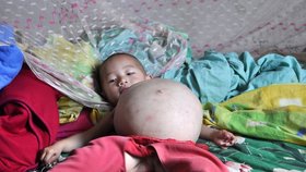 Jeden rok stará dívka v sobě nosí mrtvý plod svého sourozence
