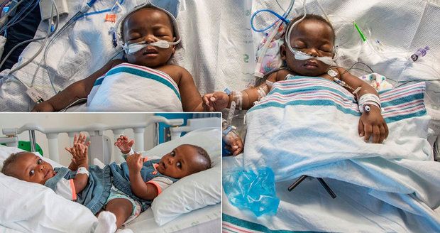 Dramatická operace siamských dvojčat: Lékaři je oddělili po osmnáctihodinové operaci