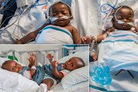 Dramatická operace siamských dvojčat: Lékaři je oddělili po osmnáctihodinové operaci