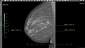 Umělá inteligence se učí mimo jiné z tisíců snímků pořízených mamografem.