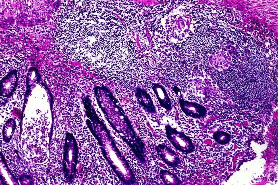 Crohnova choroba pod mikroskopem