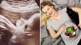 Těhotná muzikálová kráska konečně ukázala ultrazvuk: Takhle vypadá její princezna!