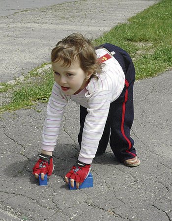 Eliška se zatím venku pohybuje pomocí kostek ze stavebnice, takzvaných kopýtek. Na rukou musí mít cyklistické rukavice, aby si je nesedřela do krve.