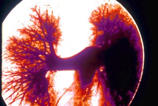 Plicní embolie: Příčiny, příznaky, vyšetření a léčba