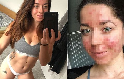 Sexy trenérku (25) fitness roky hyzdilo akné: Nový lék způsobil zázrak!