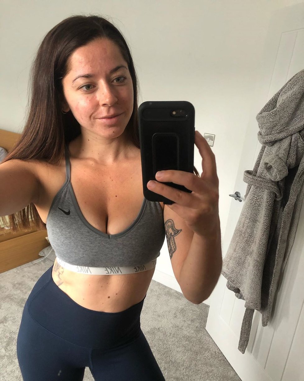 Fitness trenérku Emily Keelovou trápilo masivní akné.