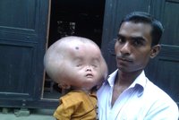 Hlava dvouletého chlapečka z Bangladéše váží skoro deset kilo a je velká jako fotbalový míč