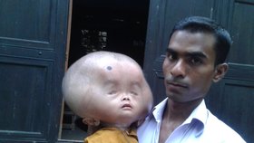 Hlava dvouletého chlapečka z Bangladéše váží skoro deset kilo a je velká jako fotbalový míč