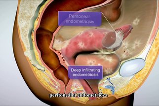 Endometrióza Endometrióza