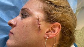 Hostem Epicentra byla i pacientka Michala Jiráčková, kvůli melanomu, ji museli lékaři odstranit pihu z tváře.