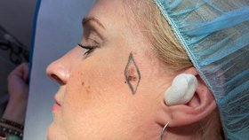 Hostem Epicentra byla i pacientka Michala Jiráčková, kvůli melanomu, ji museli lékaři odstranit pihu z tváře.