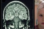 Míša trpí epilepsií, pomoci mu může operace mozku.