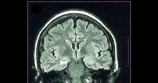 Mozek epileptika