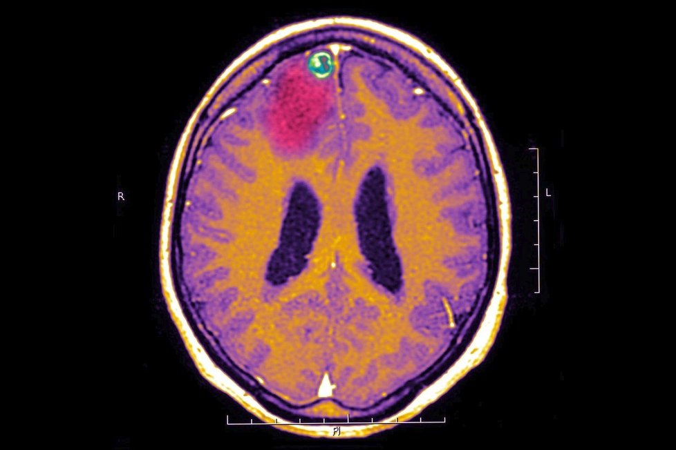 Mozek epileptika (Ilustrační foto)