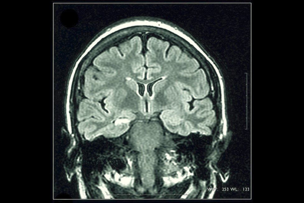 Mozek epileptika