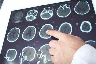 Léčba epilepsie pomocí operace mozku