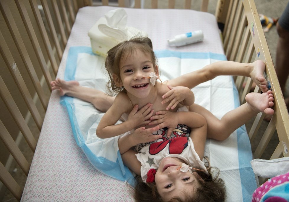 Eva a Erika se narodila jako siamská dvojčata. Po operaci je jim mnohem lépe.