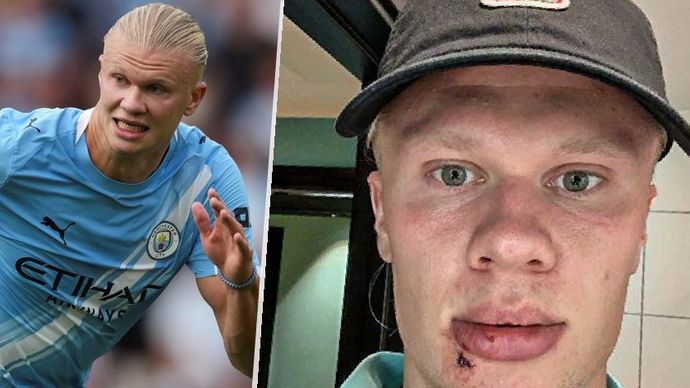 Hvězdný fotbalista měl menší nehodu, kvůli které musel na šití...