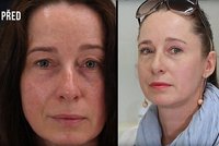 VIDEO: Operace očních víček omladí až o 10 let