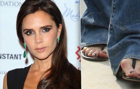 Co je to hallux? Dejte si pozor, ať nedopadnete jako Victoria Beckham! 