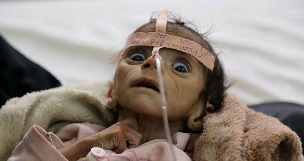 Srdceryvný snímek: Pětiměsíční chlapeček vyhladověl k smrti, jídlo mu vzala válka