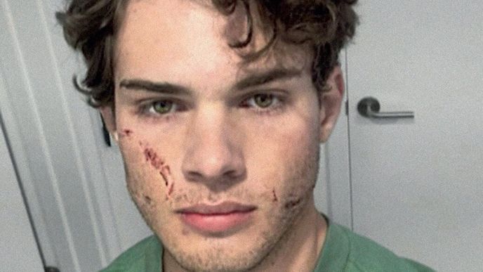 Clavicular a další „hvězdy“ looksmaxxingu propagují třeba úpravy čelisti kladivem nebo bělení zubů peroxidem vodíku. Ani jedno není dobrý nápad. Clavicular a další „hvězdy“ looksmaxxingu propagují třeba úpravy čelisti kladivem nebo bělení zubů peroxidem vodíku. Ani jedno není dobrý nápad.