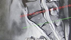 Turek vzkázal z nemocnice: Mám vyhřezlou ploténku a to poměrně drsně