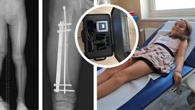 Převratná operace v Brně: Lucinka (9) si prodloužila nohu! 1 cm za 14 dní a bezbolestně 