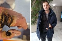 Tomáše (38) popálil proud: Ruku mu „opravili" z třísla a nohu ze spánku