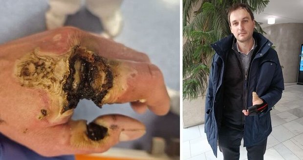 Takto vypadala ruka Tomáše (38) po zasažení elektrickým proudem, dnes se mu postupně uzdravuje.