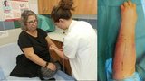 Miluše bojuje s rakovinou: Unikátní operace jí zachránila oteklou ruku