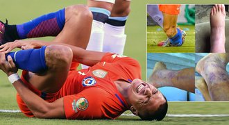 Sánchez se "pochlubil" po ostrém faulu z finále: Tak mi modrá noha