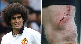 Fellaini to přehnal. Rozřízl soupeři stehno, doktor léčil sešívačkou