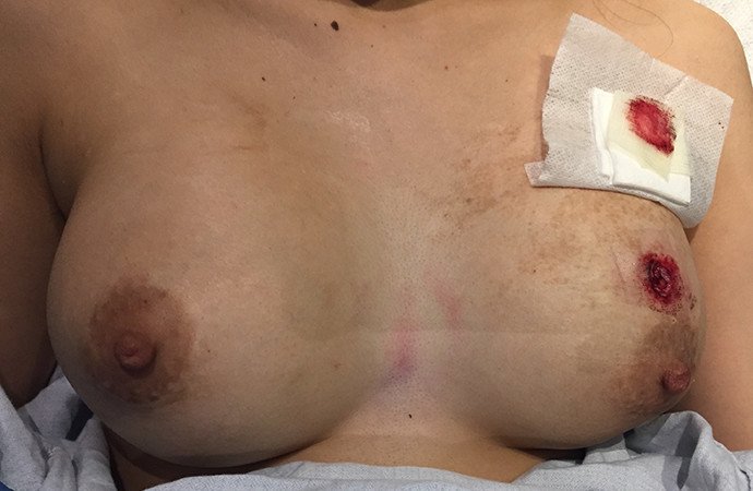 Prsní implantát zachránil ženě život