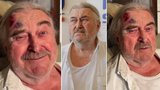 Zubožený František Ringo Čech s fialovým obličejem: Porval jsem se, tvrdil, ale pak...